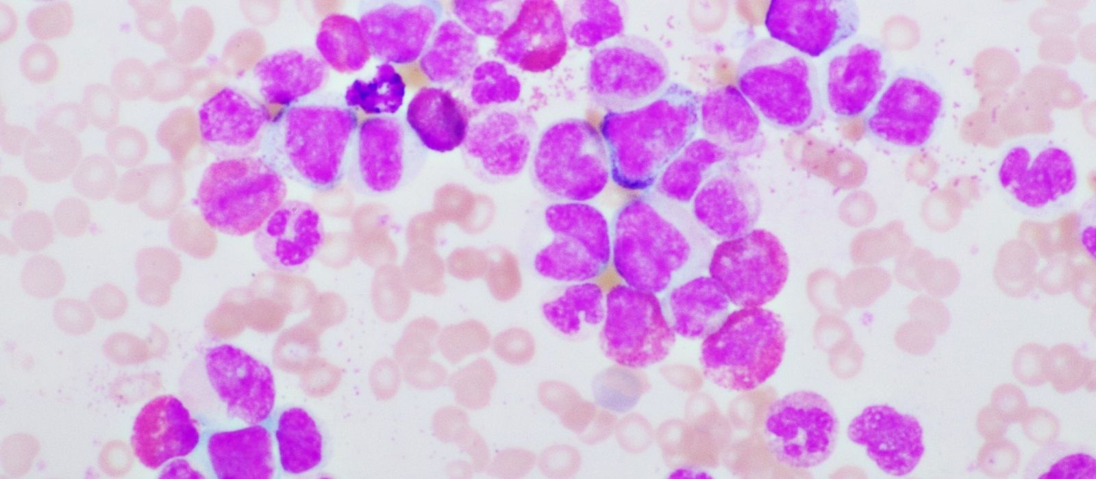 Akut Miyeloid Lösemi (AML) Akut Miyeloid Lösemi (AML)