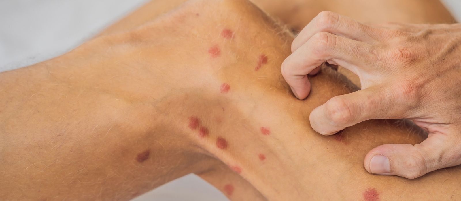 İmmün Trombositopenik Purpura (ITP) İmmün Trombositopenik Purpura (ITP)