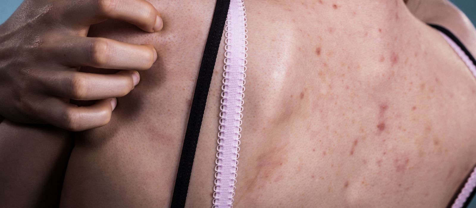 Trombosit Düşüklüğü (Trombositopeni)