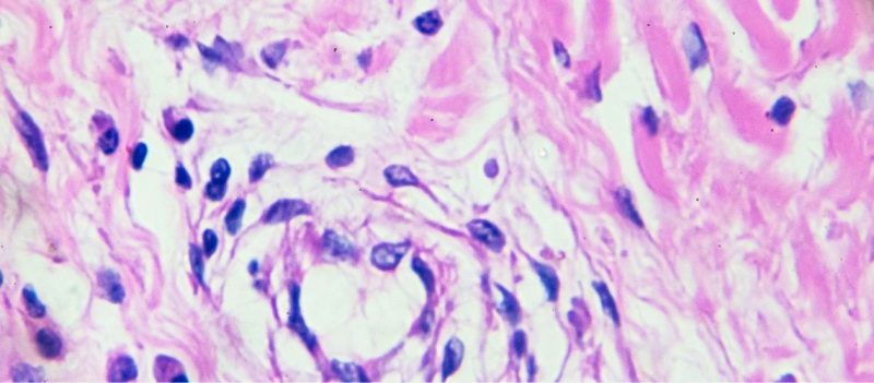 Burkitt Lenfoması Nedir?