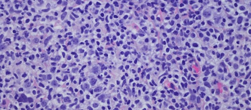 Hodgkin Lenfoma Döküntüsü Nasıl Görünür?