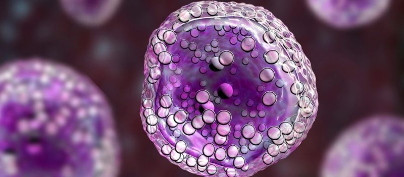 Lenfoblastik Lenfoma (LL)