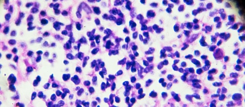 Mantle Hücreli Lenfoma: Nedir ve Nasıl Tedavi Edilir?