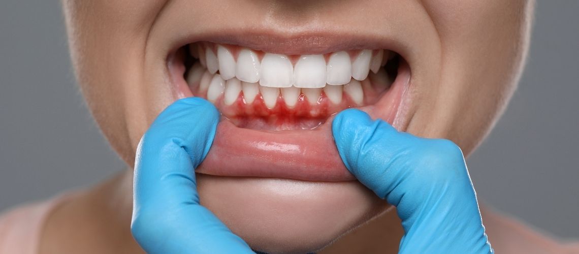 Lösemi ve Diş Eti Kanaması Arasındaki Bağlantı Nedir?