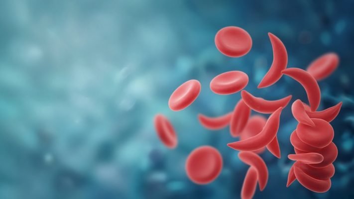 Orak hücreli anemi: normal ve orak şekilli alyuvarlar. Doç. Dr. Mahmut Bakır Koyuncu